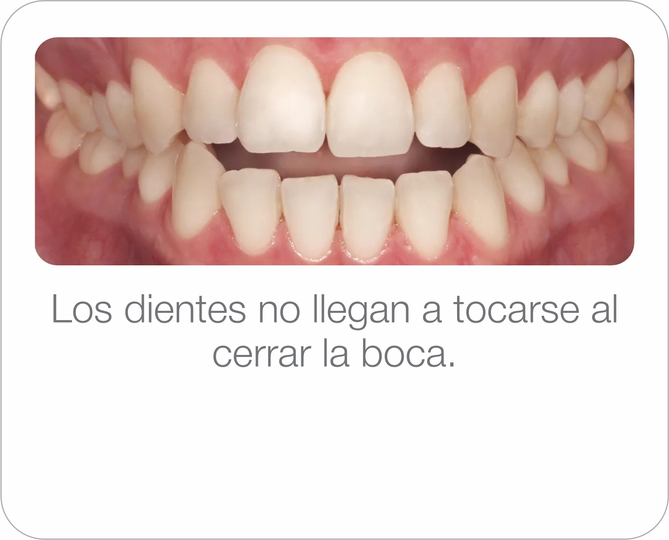 Caso real - Mordida abierta